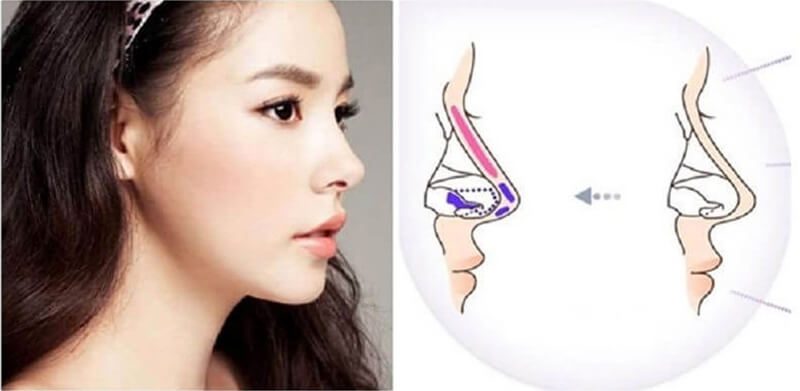 Trong quá trình nâng mũi dùng đến sụn ở khu vực vành tai